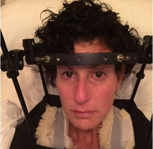 Woman wearing halo brace for spine stabilization before surgery with Dr. Bertagnoli