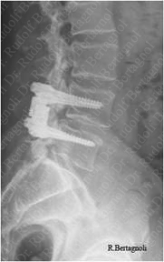 Dynamic Stabilization System Lat View