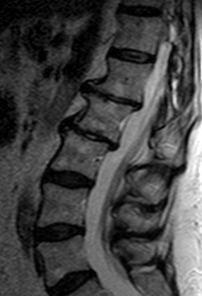 degenerative disc disease