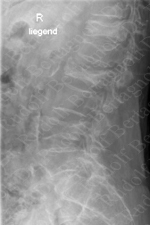 Preoperative X-ray with Multiple Fractures