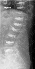Postoperative X-ray with Osteofix Implants